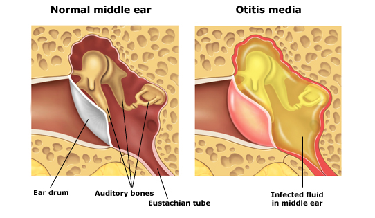 inflammation in the inner ear/نوید سلامت