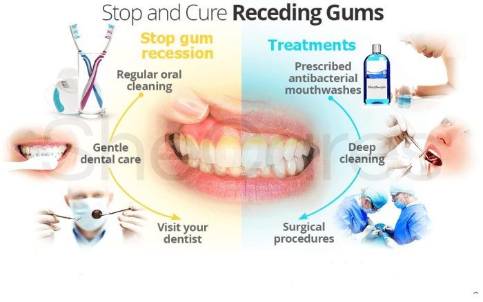 Prevent receding gums/نوید سلامت