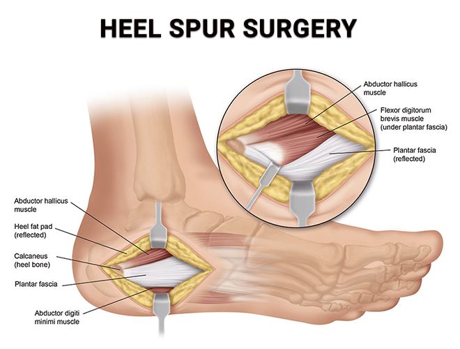 heel spur surgery/نوید سلامت