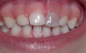 Tooth discoloration/نوید سلامت