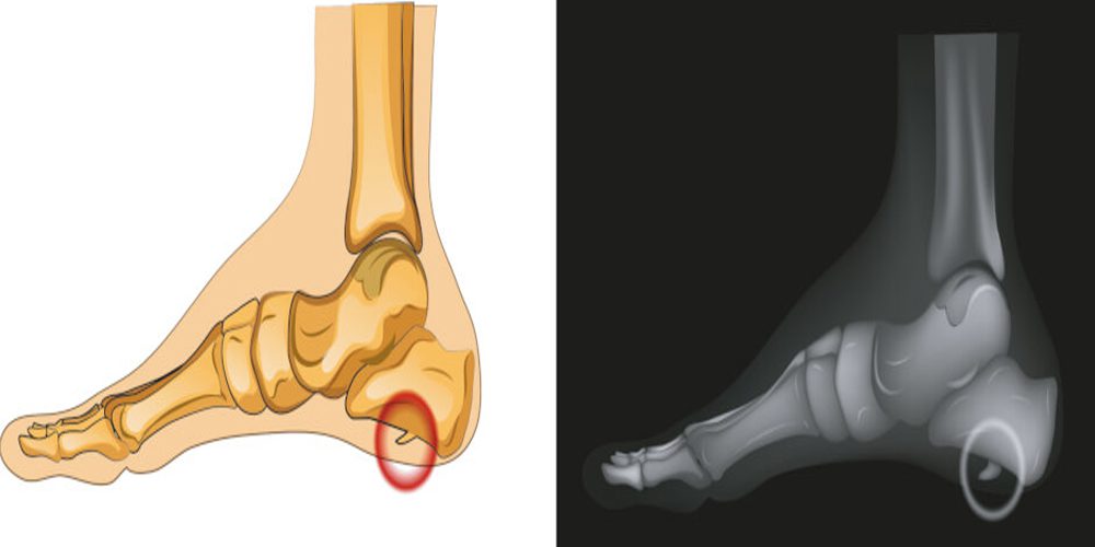 What is a heel spur/نوید سلامت