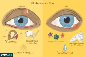 Symptoms of eyelash/نوید سلامت