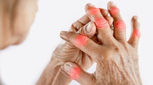 Psoriatic arthritis/نوید سلامت