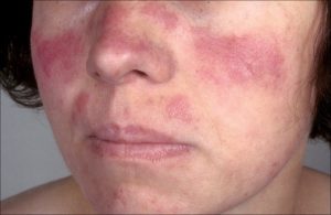 Systemic lupus erythematosus/نوید سلامت