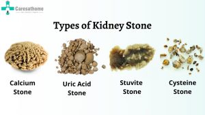 Types of kidney stones/نوید سلامت