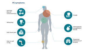 Symptoms of pulmonary embolism/نوید سلامت