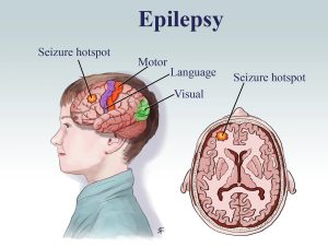  epilepsy occur/نوید سلامت