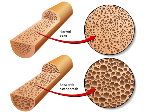 What is osteoporosis/نوید سلامت