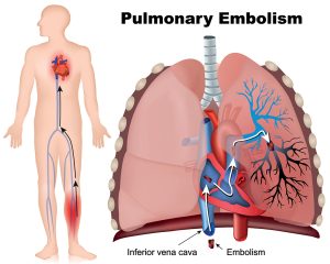 What is pulmonary embolism/نوید سلامت