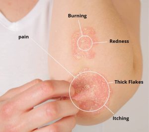 Psoriasis/نوید سلامت