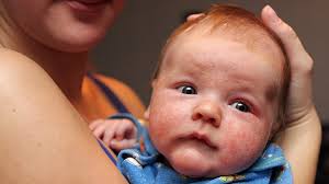 Infant eczema