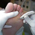 میخچه چیست؟ علت‌ها، علائم، روش‌های پیشگیری