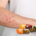 نشانههای آلرژی دارویی چیست؟